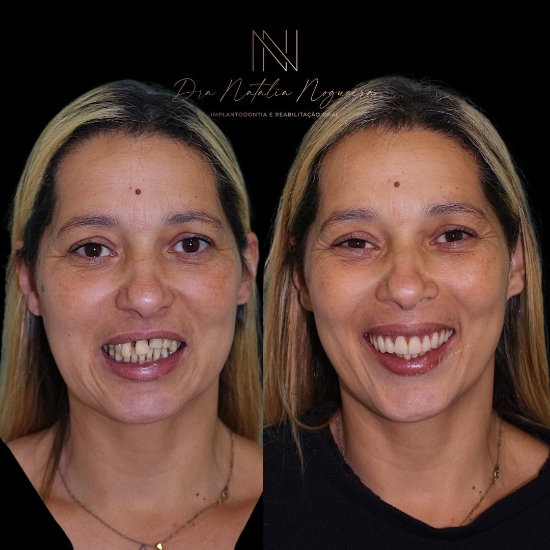 Reabilitação Estética (antes e depois)